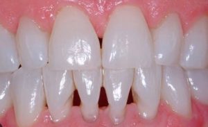 embrasure spaces between teeth