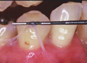 tissue sloughing