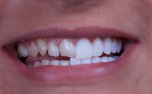veneers