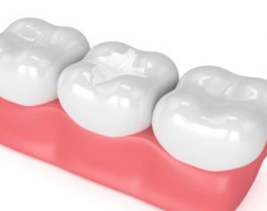 dental filling